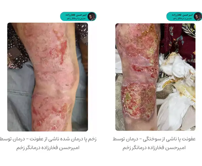 درمان عفونت سوختگی توسط امیرحسن فخارزاده