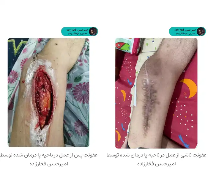 درمان عفونت محل عمل توسط امیرحسن فخارزاده