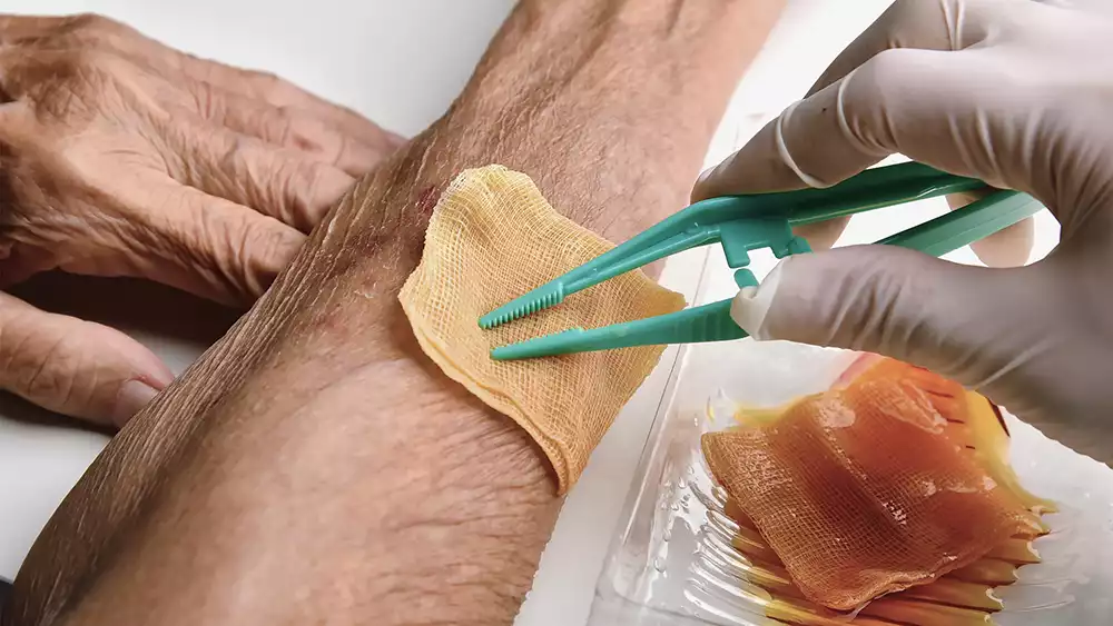 عسل در درمان زخمهای دیابتی