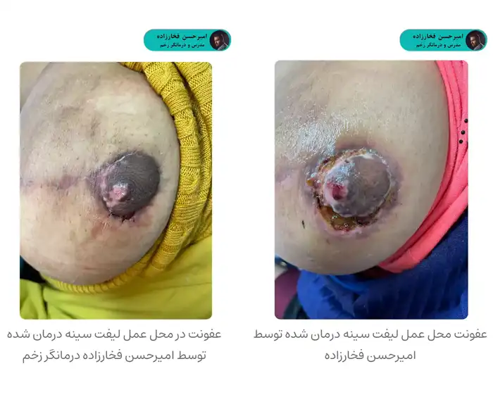 نمونه درمان عفونت سینه - امیرحسن فخارزاده